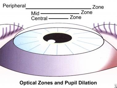 Optical zones and pupil dilation discussed by radi
