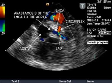 This is an intraoperative transesophageal, transve
