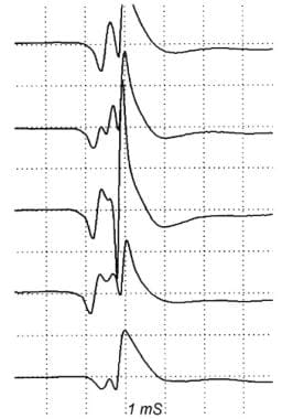 Action potentials from a single motor unit in a pa
