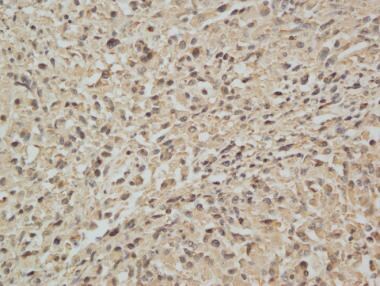Pathology of nonmesothelial cancers of the pleura.