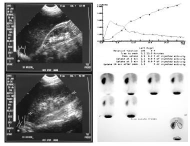 Renal artery stenosis/renovascular hypertension. L