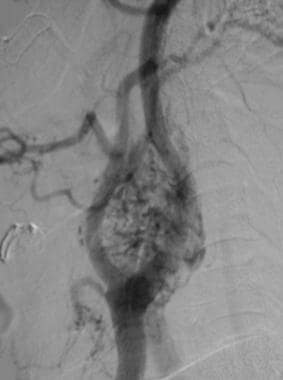 Carotid body tumor. Lateral angiogram shows a dens