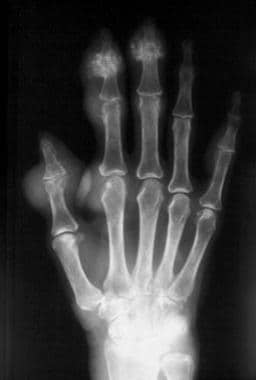 Radiograph of the hand. On this image of chronic t