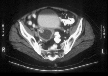 CT image through the upper uterus shows fluid that