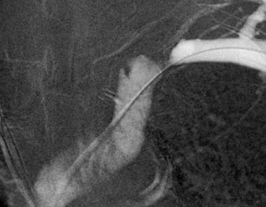 Contrast-enhanced venogram shows critical stenosis