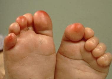 Chilblains Overview - Mayo Clinic