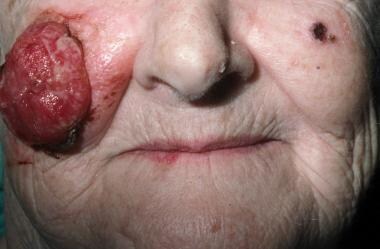 A large lesion of the right cheek amenable to repa
