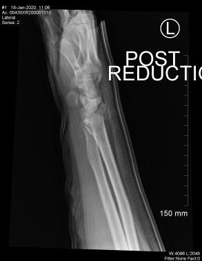 Reduction obtained by volar inversion of hand on f