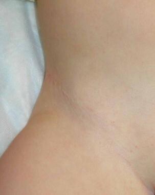 Skin-graft donor site. Donor site in right inguina