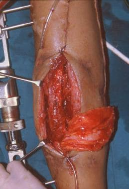 Clinical Case 1. Intraoperative picture. The osteo