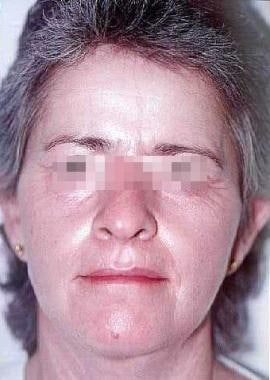 Six months after procedure. Female patient with sk