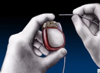 Example of implantable neurostimulator for deep br