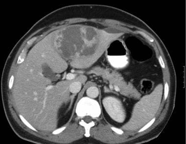 Amebic Liver/Hepatic Abscesses. CT scan of the abd
