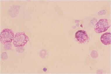 Bone marrow aspirate, toluidine stain, low magnifi