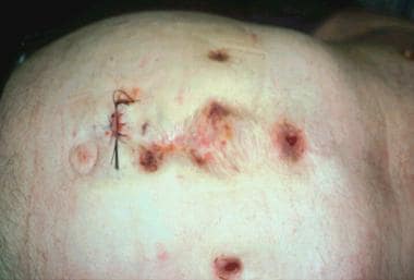 Dissertation aspects of echinococcosis