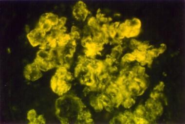 Focal lupus nephritis. International Society of Ne