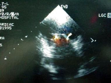 Double Orifice Mitral Valve. Two-dimensional echoc