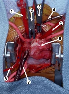 Intraoperative photograph. (1) A cardioplegia cath