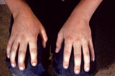 Elementary school child with fifth disease. Image 