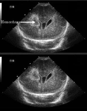 Intraventricular hemorrhage (IVH) with periventric