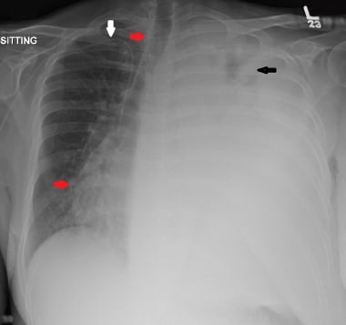 This chest radiograph is of a 47-year-old male pat