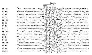Slow (&lt; 2.5 Hz) electroencephalographic spike a