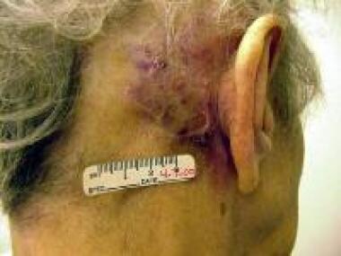 Cutaneous angiosarcomas primarily affect elderly p