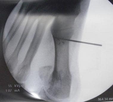 Scarf osteotomy to correct severe hallux valgus de