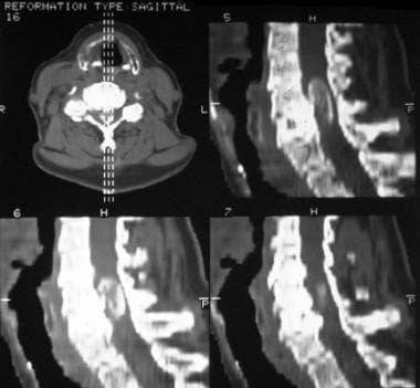 Sagittal reformation nonenhanced CT scan shows a c