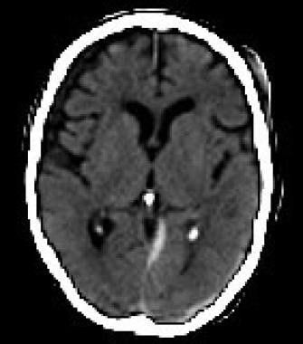 Tentorial subdural hematoma in an adult with traum