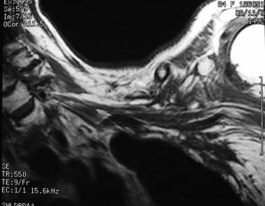 Brachial plexus injury. Postirradiation changes in