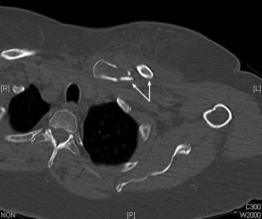 Medial clavicular fracture without injury to the s