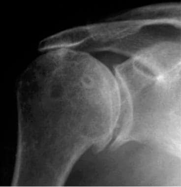 Shoulder, rotator cuff injury (ultrasonography). A
