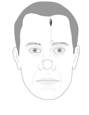 The pedicle is severed in 2-3 weeks, and the flap
