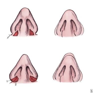 Basic closed technique for rhinoplasty. Nasal base