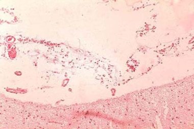 Anthrax infection. Histopathology of hemorrhagic m