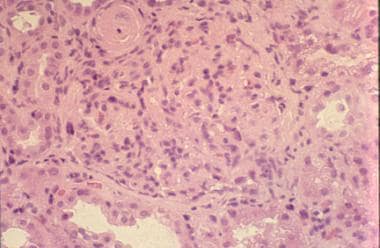 Diffuse lupus nephritis with hypertensive vascular