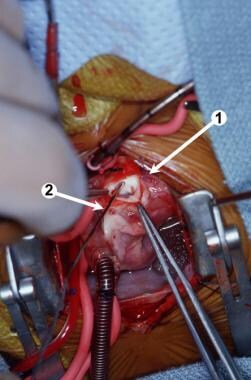 Intraoperative photograph. (1) A transverse anteri