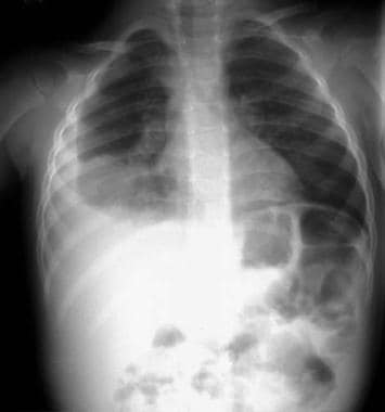 Right lower lobe consolidation in a patient with b