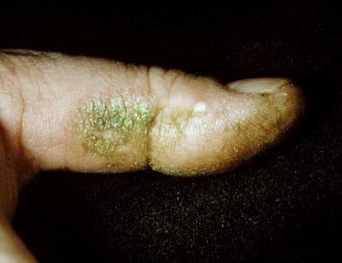 Finger of a florist with an eczematous plaque caus
