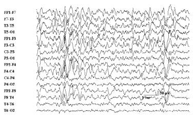 Slow (&lt; 2.5 Hz) electroencephalographic spike a
