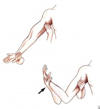 Passive flexion of the forearm reduces the baselin