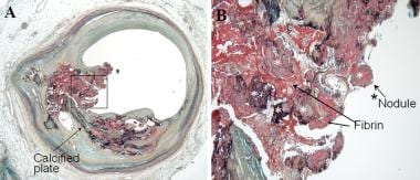 Vulnerable plaque pathology. Calcified nodule. A: