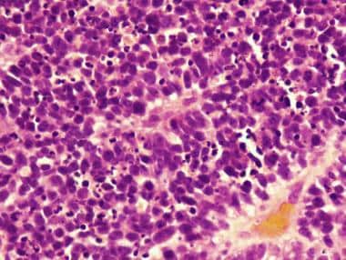 Undifferentiated blue cells in a primitive neuroec
