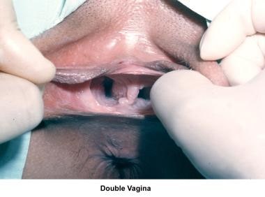 Infertility. Double vagina. Image courtesy of Jair