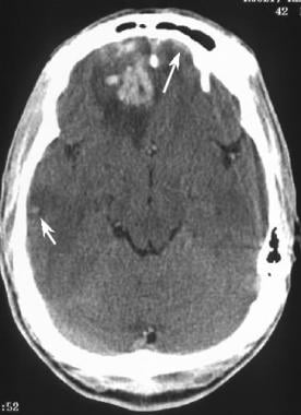 Acute brain contusion. Axial CT scan obtained in a