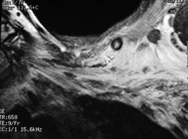 Brachial plexus injury. Postirradiation changes in