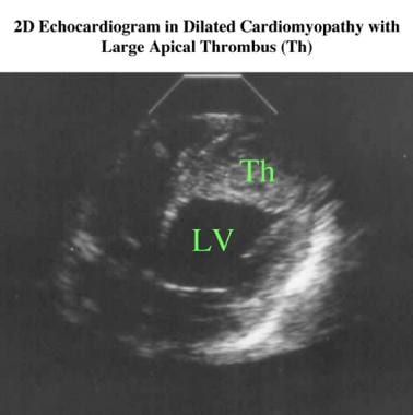Two-dimensional echocardiogram in a patient with i