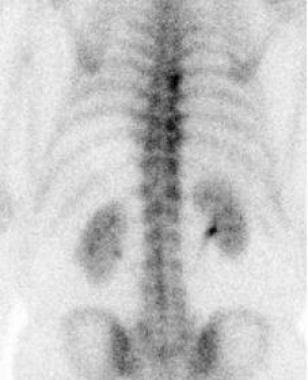 Bone scan (posterior image) demonstrates increased