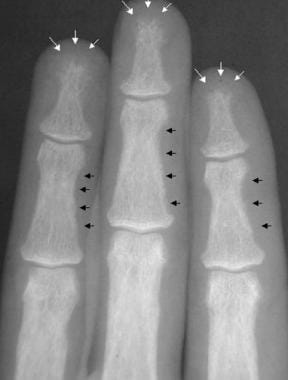 Radiograph of the middle phalanges in a patient wi